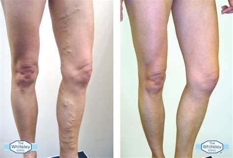 Varicose Veins - Everything You Need To Know - My Weekly