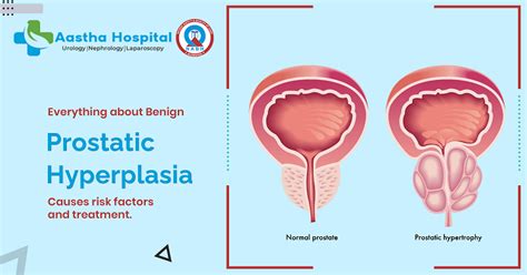 Benign Prostatic Hyperplasia