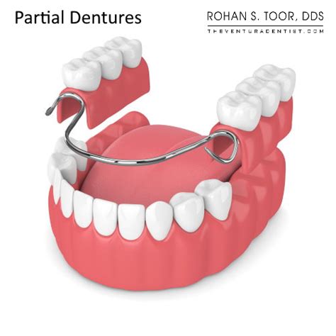 Partial Dentures: Process, Problems, Time it takes, Types, Lifespan ...