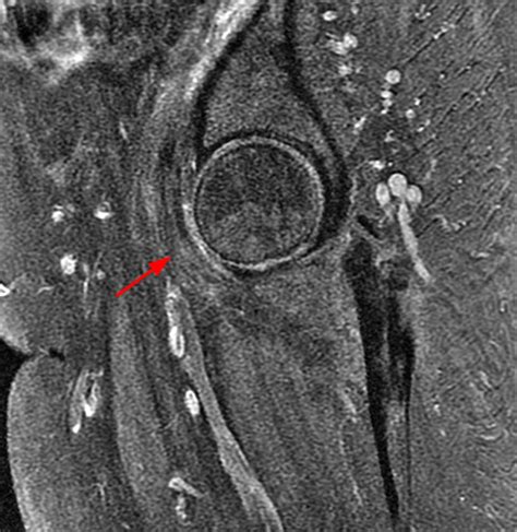 Iliopsoas Tendinopathy - Radsource