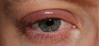 Blepharitis and Demodex - CLEAR VIEW EYE ASSOCIATES