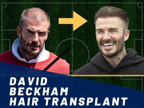 David Beckham Hair Transplant - Hair Loss & Technical Analysis