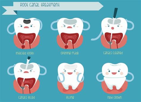 A Root Canal Dentist Explains: What You Need to Know About Root Canal ...