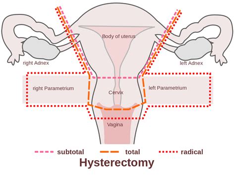 Cashless Hysterectomy Surgery by Laparoscopic Method | Mahapatra ...