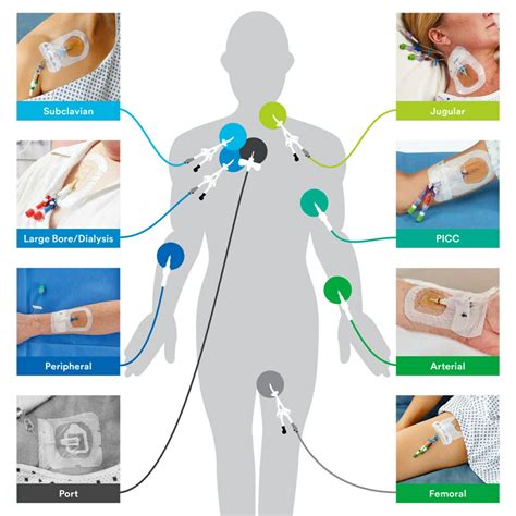 3M™ Tegaderm™ CHG Chlorhexidine Gluconate I.V. Securement Dressing | 3M United Arab emirates