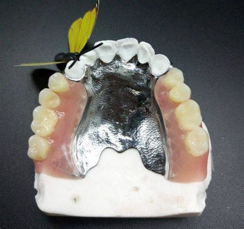 China Cast Partial Denture with Metal Palatal Design Cpd - China Cast Framework, Acrylic Dentures