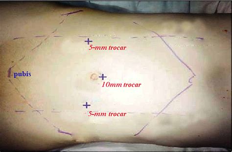 Cureus | Laparoscopic Transabdominal Preperitoneal Technique for Inguinal Hernia Repair in Adults