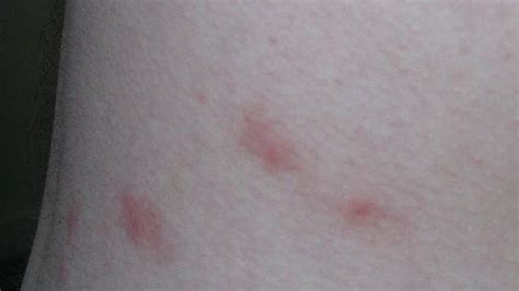 Flea Bites: Symptoms and Treatments