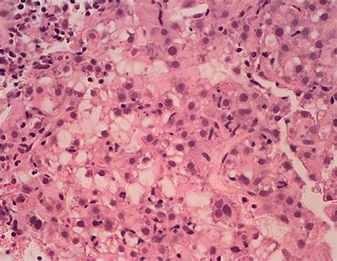 Biopsy of the liver lesion showed well-differentiated HCC.... | Download Scientific Diagram