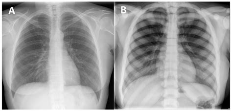 Osteopetrosis