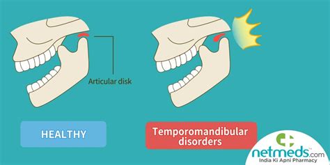 TMJ (Temporomandibular Joint) Disorders: Symptoms And More, 58% OFF