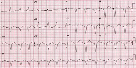 ECG Quiz: Drug-induced torsades de pointes