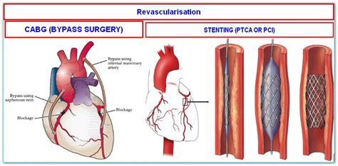 FACTS ABOUT STENT SURGERY TO THE HEART (ANGIOPLASTY OR PTCA OR PCI) Heart Specialist Hyderabad