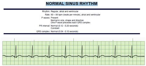 CARDIAC RHYTHMS NORMAL SINUS RHYTHM Diagram | Quizlet