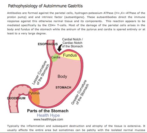 Auto-Immune Atrophic Gastritis: malabsorption - can lead to NET tumours |Atrophic Gastritis ...