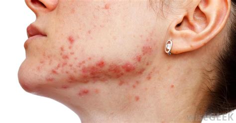 Accutane (Isotretinoin): General info, Warnings & Side Effects