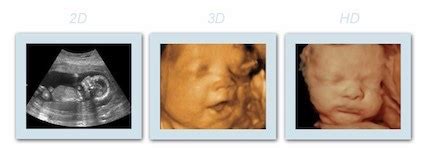 What is the difference between 2D, 3D, 4D, and HD? - First Glimpse Ultrasound