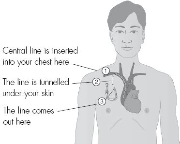 Tunneled Central Venous Catheter Placement