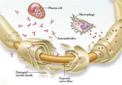 Chronic Inflammatory Demyelinating Polyneuropathy Symptoms, Causes, Treatment