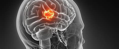 Understanding Glioblastoma: The Most Common Type Of Malignant Brain Tumor