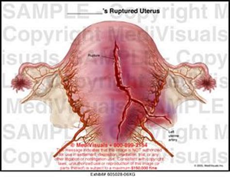 MediVisuals Ruptured Uterus Medical Illustration