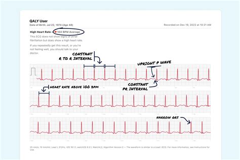 Sinus Tachycardia Vs. Supraventricular Tachycardia (Sustained) on Your ...