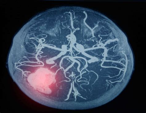 Brain Aneurysm Surgery: Overview