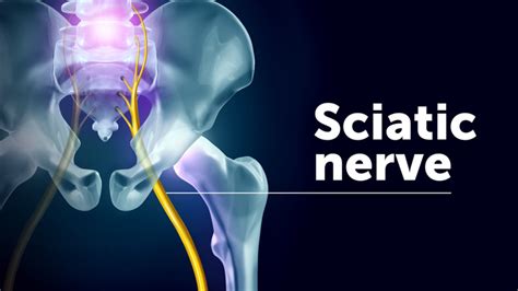 Sciatica: Symptoms and causes of sciatic nerve pain | HealthPartners Blog