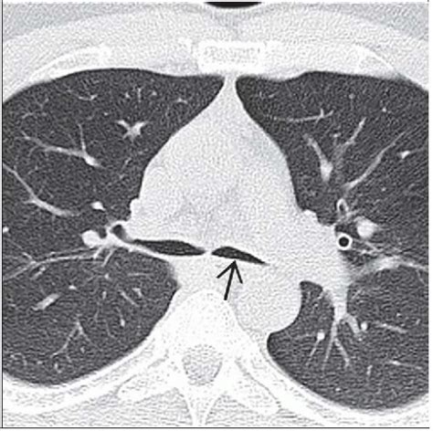 Tracheobronchomalacia | Radiology Key