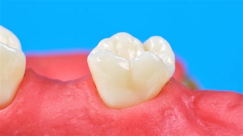 Why Is My Gum Separating From My Back Tooth | GDG