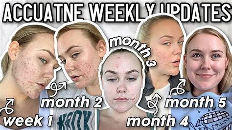 My Accutane Journey: *Weekly Updates,* Side Effects, & Post Accutane ...