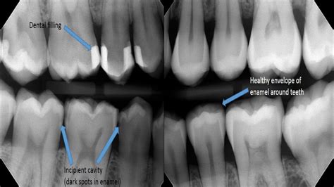 How To See A Cavity Like A Dentist | Phan Family Dentistry