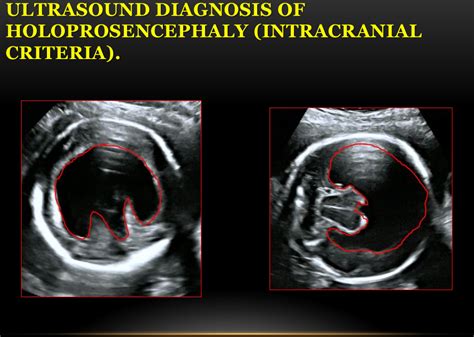 What is Holoprosencephaly? | Diagnostic medical sonography, Ultrasound, 4d ultrasound