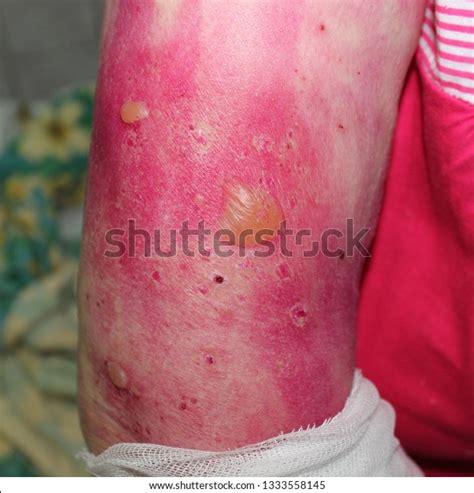 24 Bullous Pemphigoid Royalty-Free Images, Stock Photos & Pictures | Shutterstock