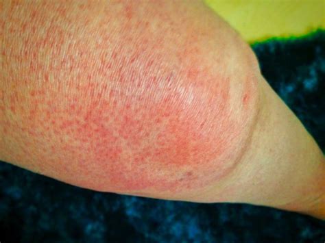 allergies-rash-swollen-knee-in-pic-hives-is-an-itchy-and-painful-rash ...