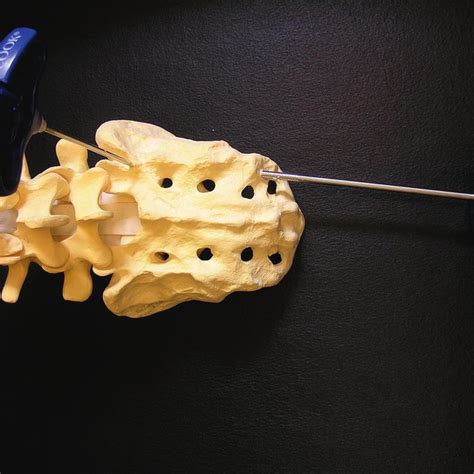 (PDF) Multicenter study to assess the efficacy and safety of sacroplasty in patients with ...