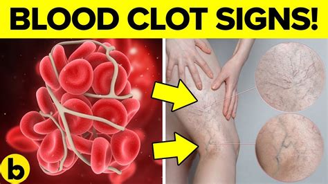 DON'T IGNORE The Warning Signs Of A Blood Clot - You're At Risk! - YouTube