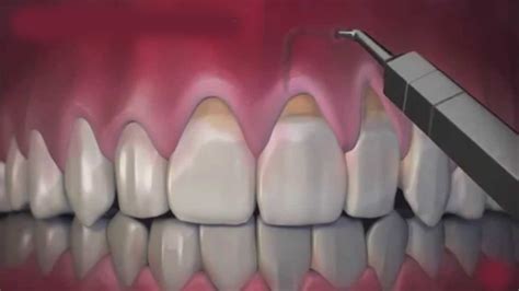 Gum Recession Treatment Essex | How Much Does Pinhole Surgery Cost?