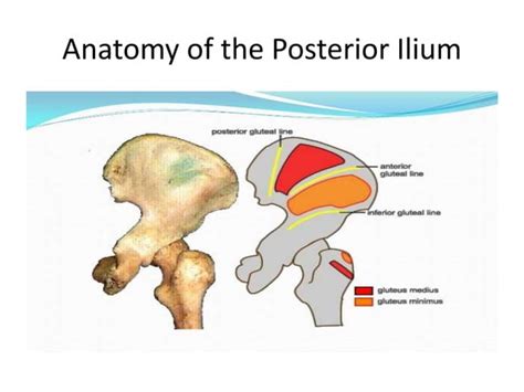 Posterior iliac crest bone graft