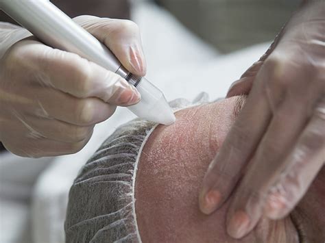 Dermabrasion: Purpose, Procedure and Risks