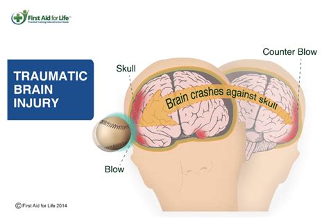 Head Injuries: When are They Serious? - Online First Aid