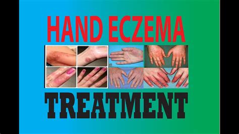 Dyshidrosis/Dyshidrotic eczema/Hand eczema/Pompholyx treatment - YouTube