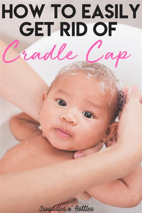 Fighting Cradle Cap- How to clear up your baby's scalp - Swaddles n' Bottles