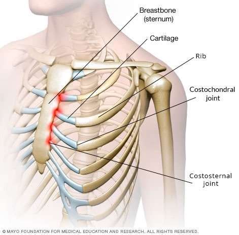 Costochondritis | Chest Pain | Symptoms and Treatment | Patient