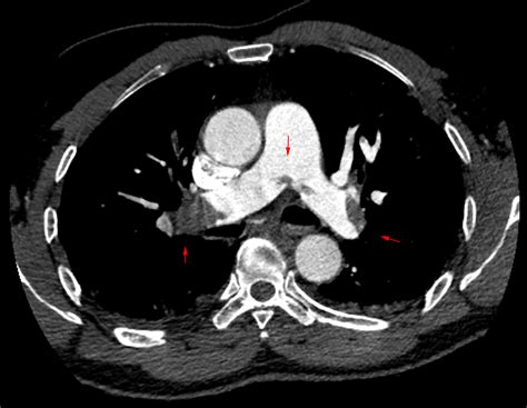 Cureus | Paradoxical Embolism Causing Myocardial Infarction in a COVID-19 Patient Presenting ...