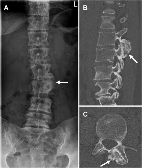 Imaging of facet joint diseases - Clinical Imaging