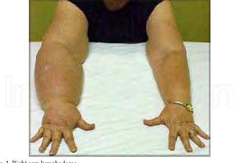 Figure 1 from 3 Arm Lymphedema as a Consequence of Breast Cancer ...