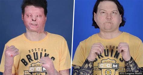 New Jersey man becomes world's first successful face and hands transplant