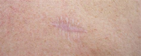 How to reduce the appearance of surgical scars – Skin Repair