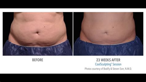 Coolsculpting: Before & After - YouTube